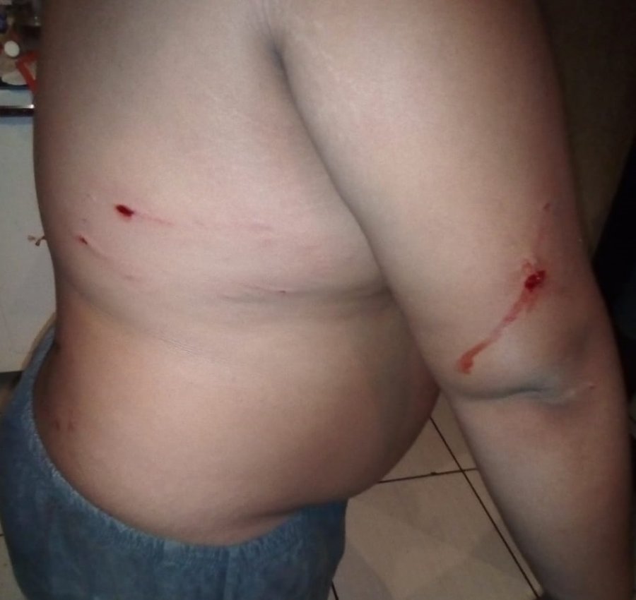 Garoto de onze anos é atacado por pitbull na cidade de Lagoa Formosa
